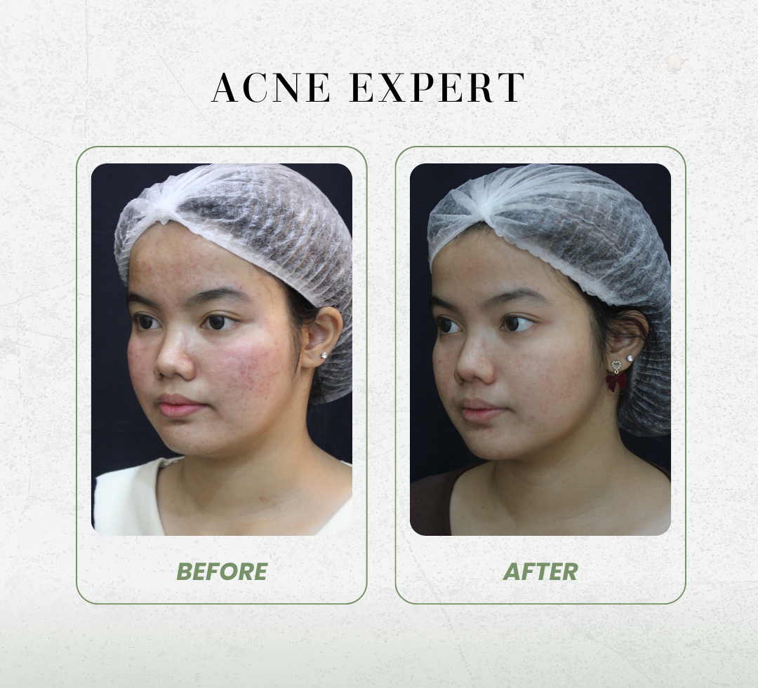 Acne expert