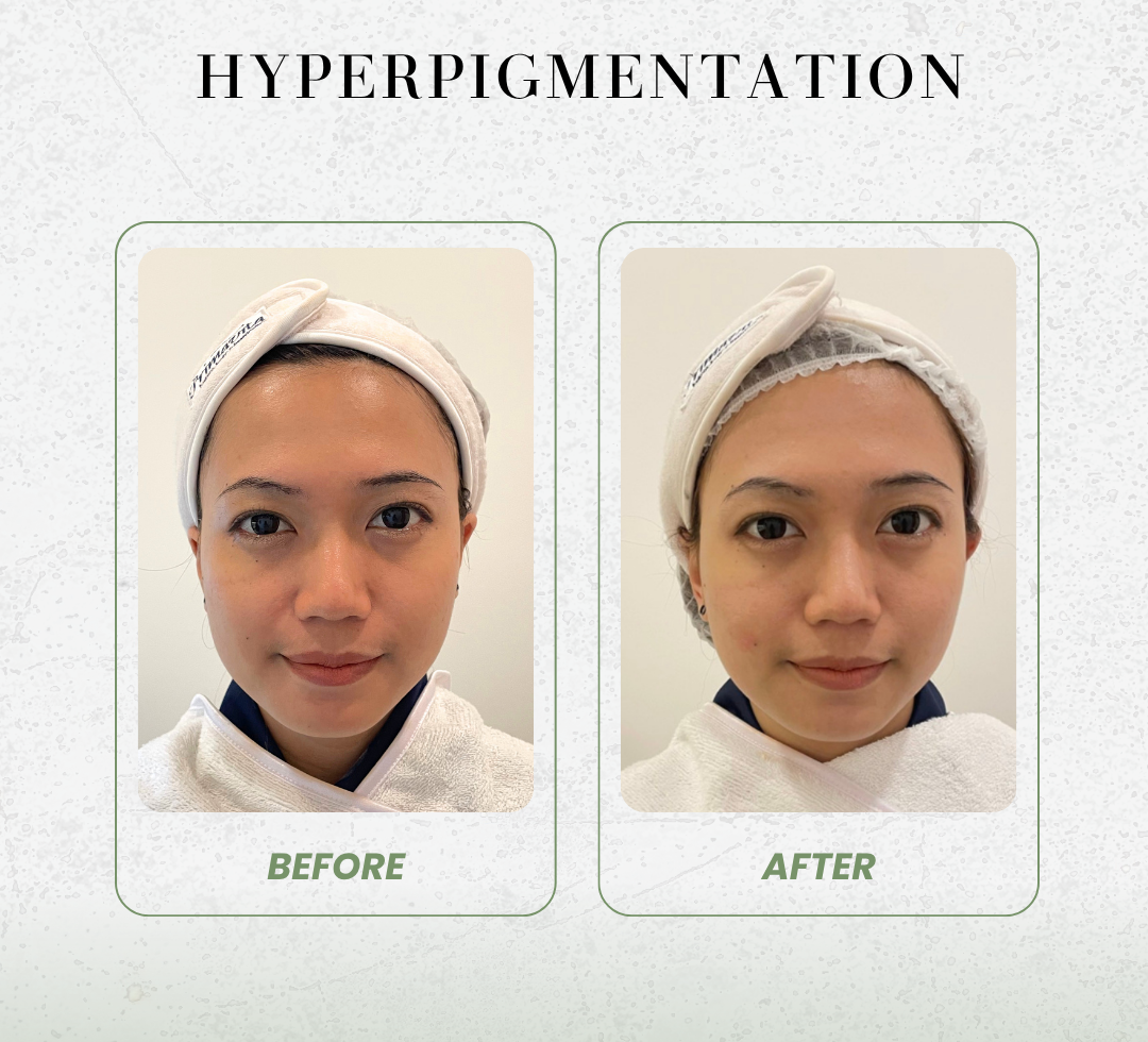 Before after hyperpigmentation
