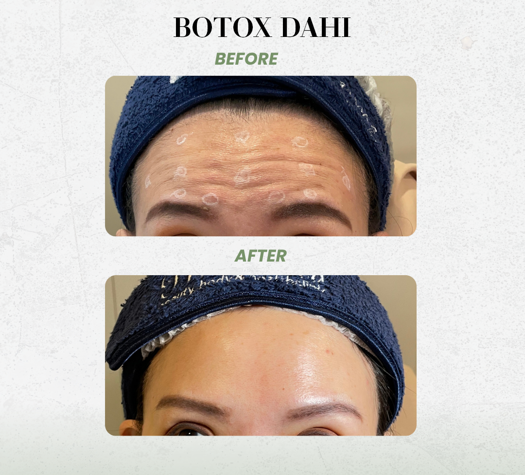 Botox