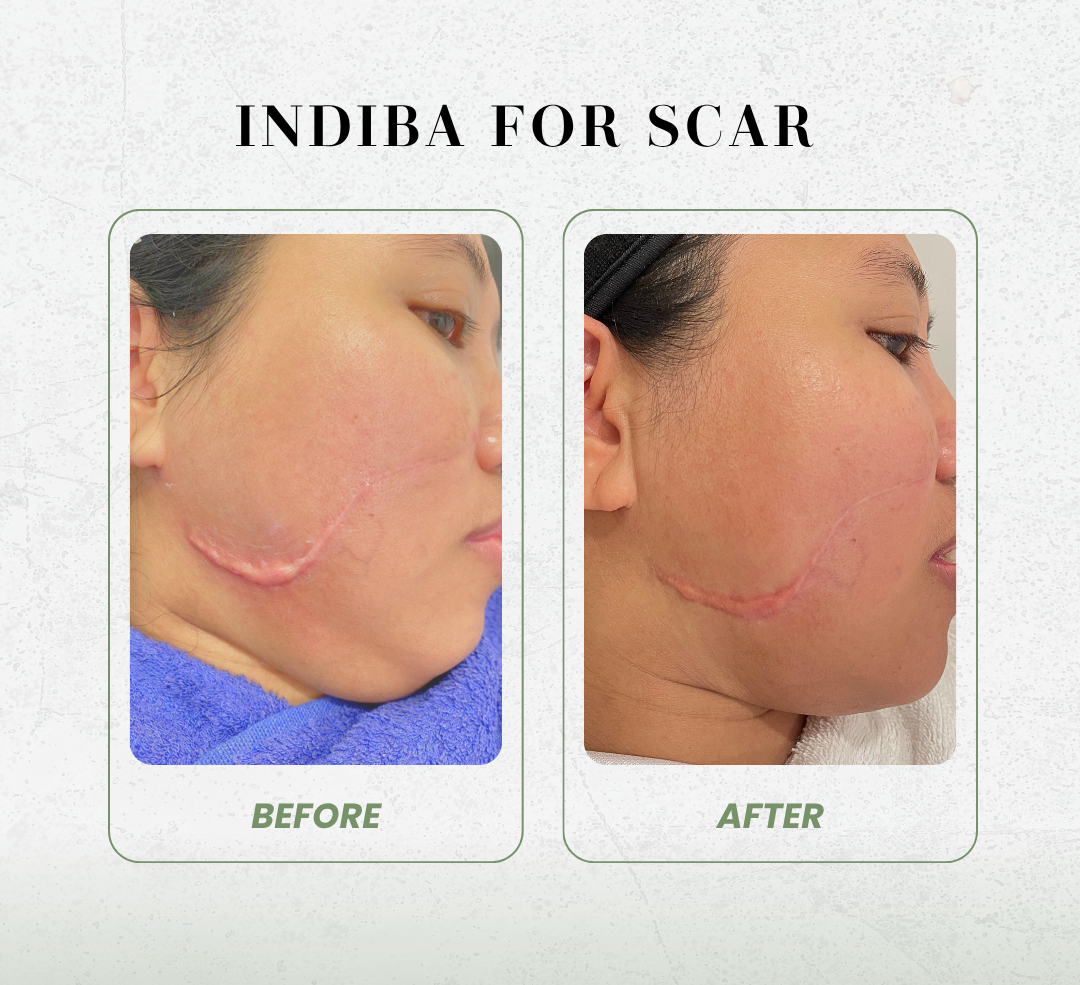Indiba scar