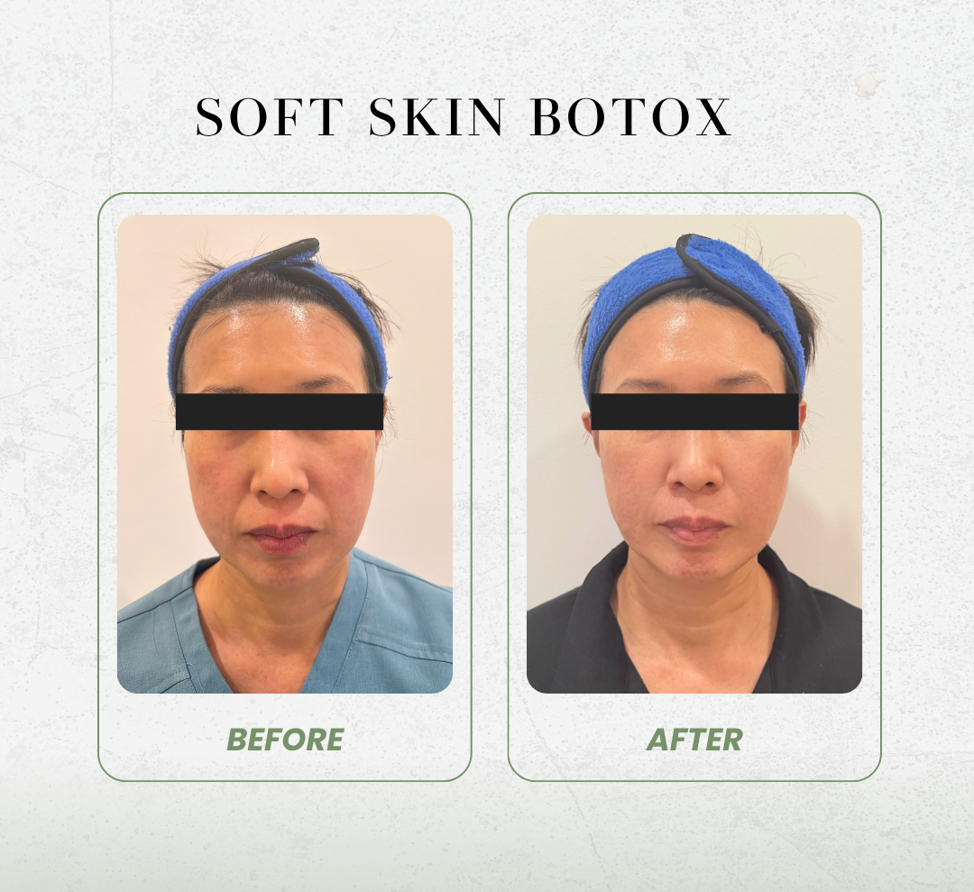 Soft skin botox