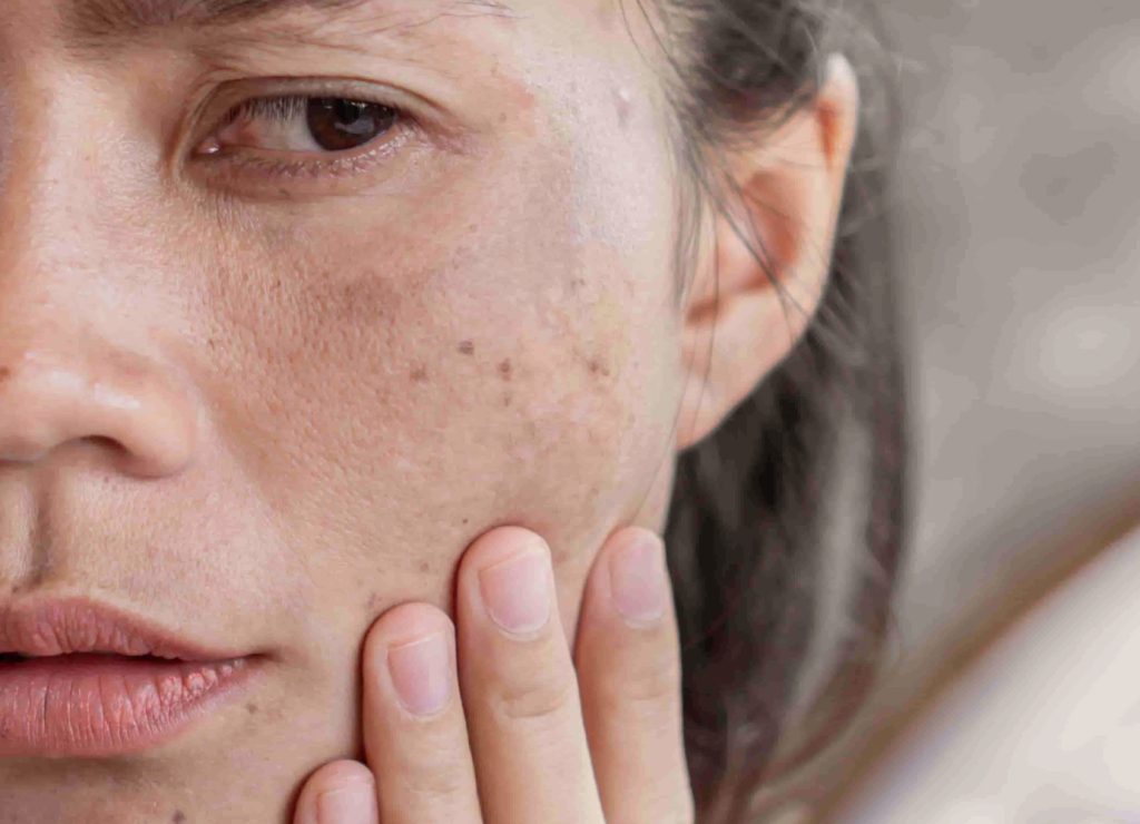 melasma-penyebab-wajah-kusam